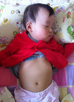 宝宝鸡胸挂什么科