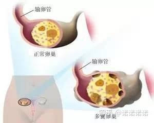 输卵管上打孔是什么意思