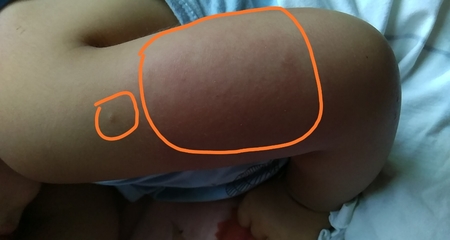 打手臂针为什么会肿