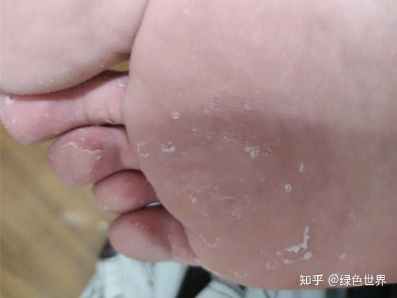 有脚气的鞋子用什么洗