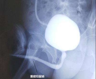 膀胱支架有什么症状