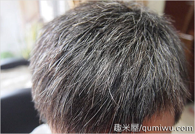 为什么头发先从两边白