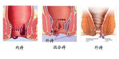 痔疮严重会导致什么