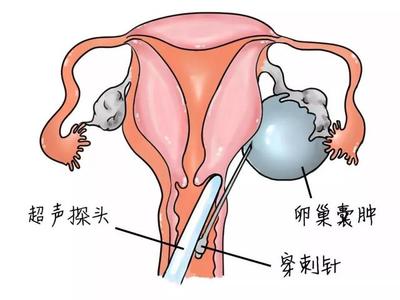 卵巢囊肿生活要注意什么