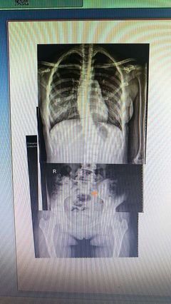 颈椎有白点是什么意思