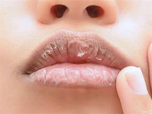 口角裂开是什么原因