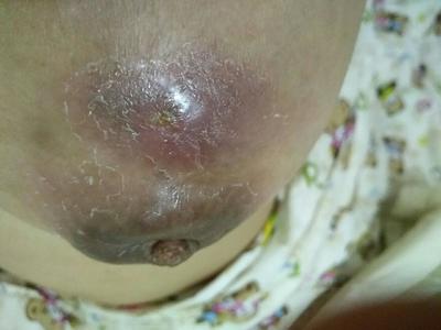 乳腺炎化脓是什么颜色