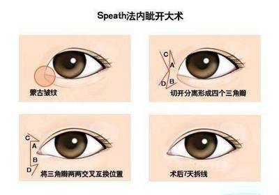 什么叫开眼角挛缩
