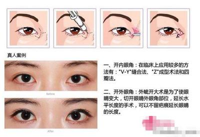 什么叫开眼角挛缩