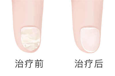得了灰指甲吃什么药