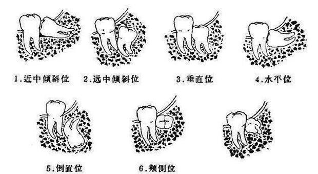 长智齿什么样的
