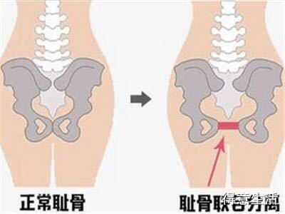 为什么顺产后耻骨痛