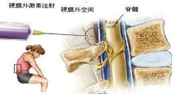 硬膜外封闭用什么药