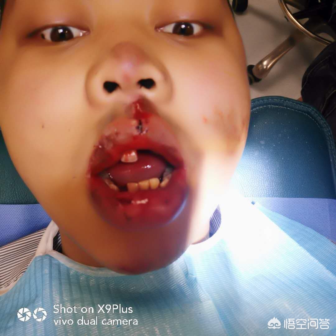 男孩门牙松了为什么不掉