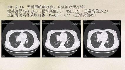 检查肺癌最好的方法是什么样的
