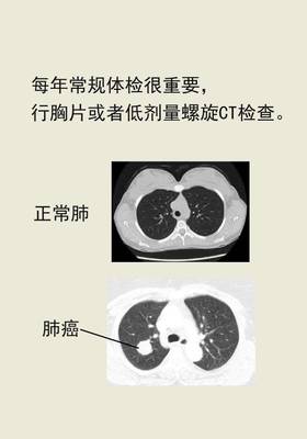 检查肺癌最好的方法是什么样的