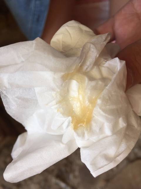白带没有了是什么症状