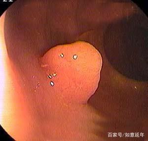 直肠癌疾病的症状是什么