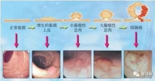 直肠癌疾病的症状是什么