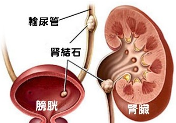 尿道管结石可以吃什么
