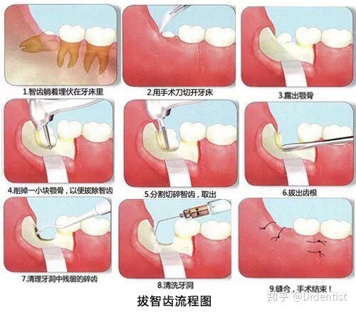 拔智齿后滴什么消炎