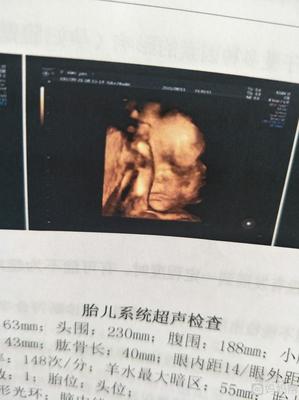 瞳胎儿内距是什么意思