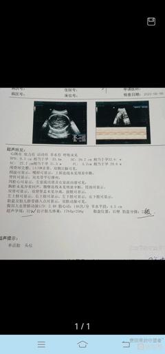 30周胎盘2级是什么意思