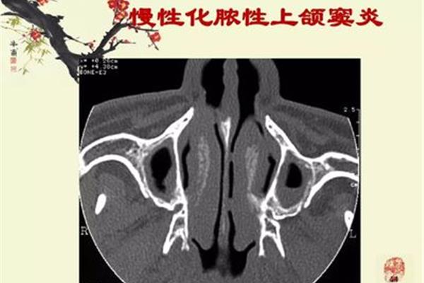 上颚窦炎是因什么影起的