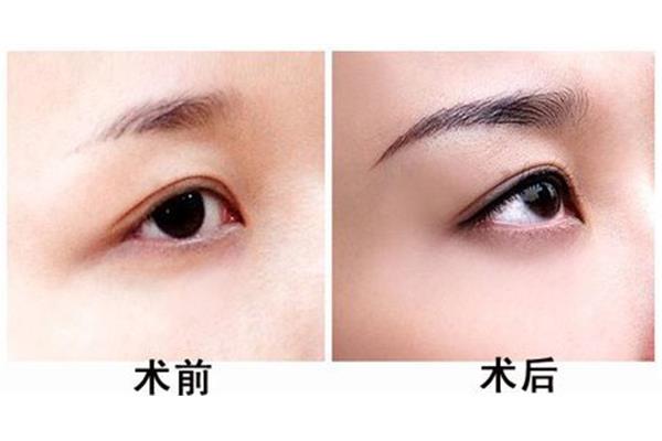 为什么纹眉不能吃海鲜