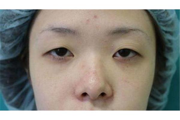 人眼睛突出来什么病