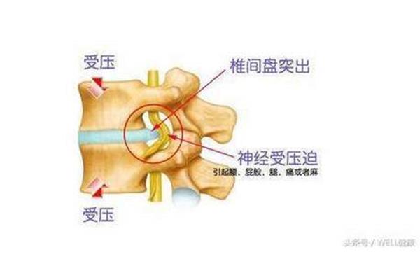 腰椎尖盘病腿疼脚麻委缩后果什么样