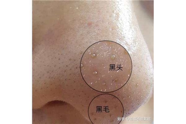 黑头严重做什么美容