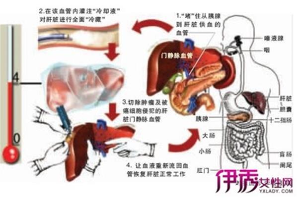 胰头癌出现黄疸 为什么