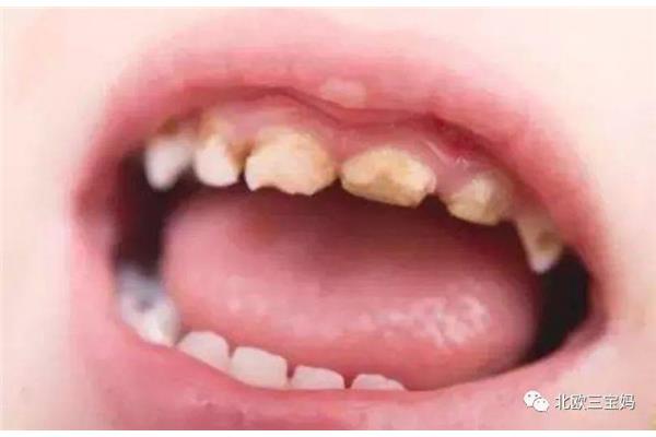 小孩烂牙齿什么原因