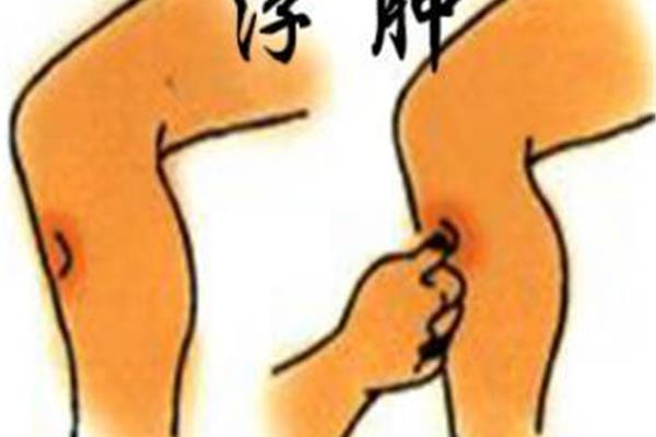 心衰为什么腿肿